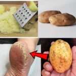 Magic Cracked Heels Home Remedy: The Potato Cure